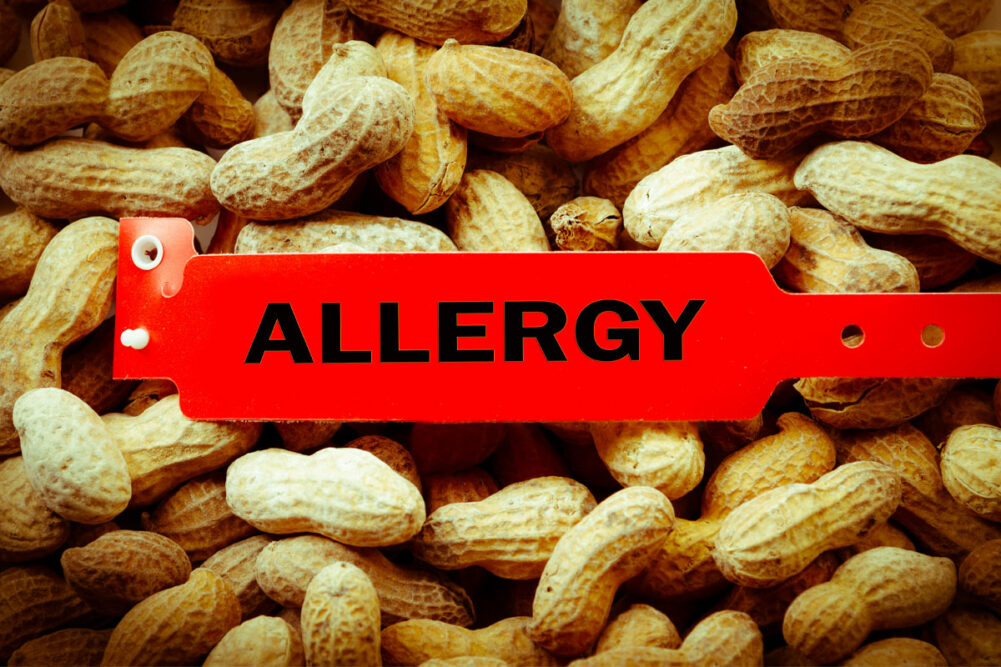 Peanut allergy image